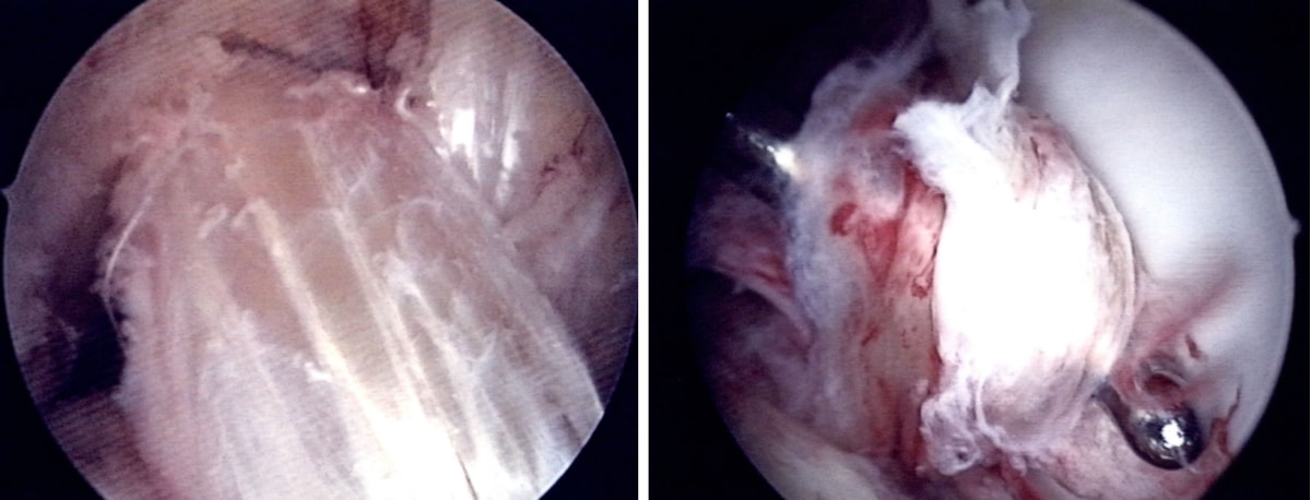 Arthroskopie: Bild eines gerissenen vorderen Kreuzbandes (links) und eines rekonstruierten Kreuzbandes (rechts)